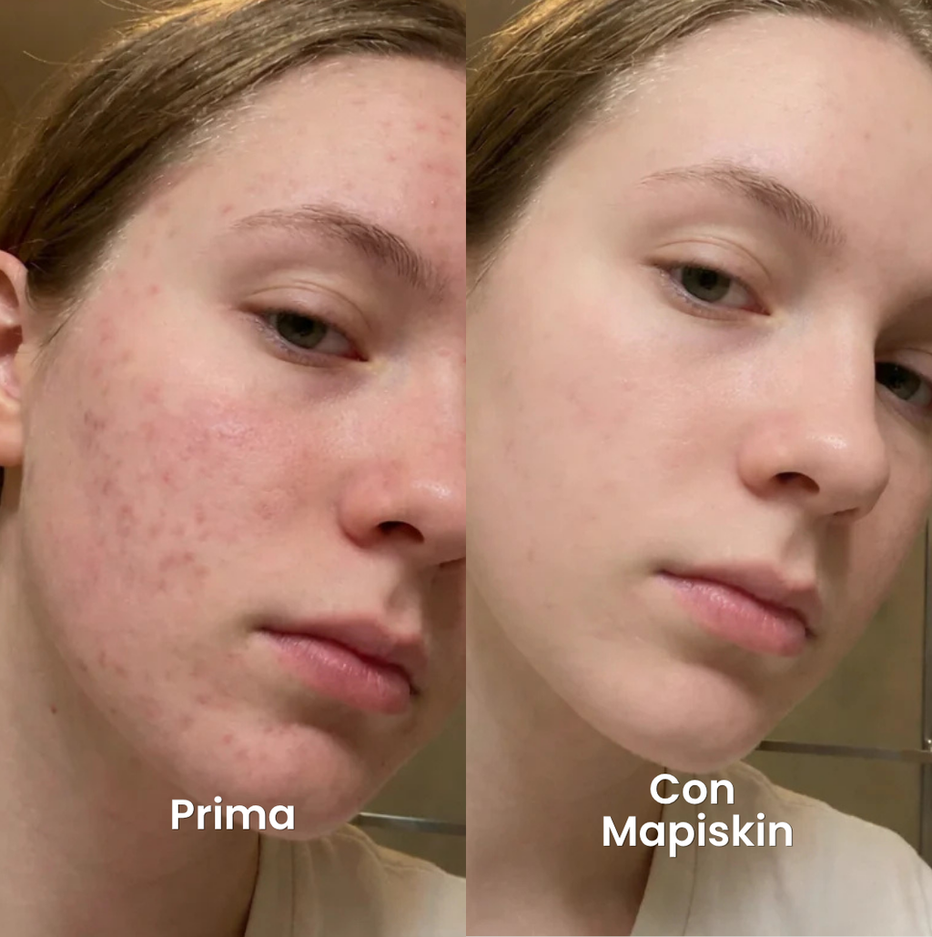Sistema di micro-infusione per Cicatrici da Acne