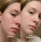 Sistema di micro-infusione per Cicatrici da Acne