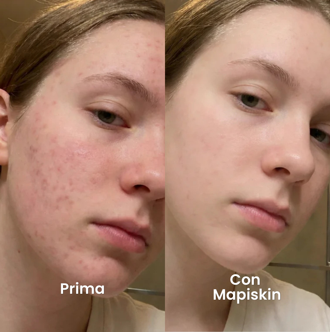Sistema di micro-infusione per Cicatrici da Acne
