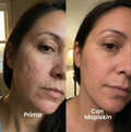 Sistema di micro-infusione per Cicatrici da Acne