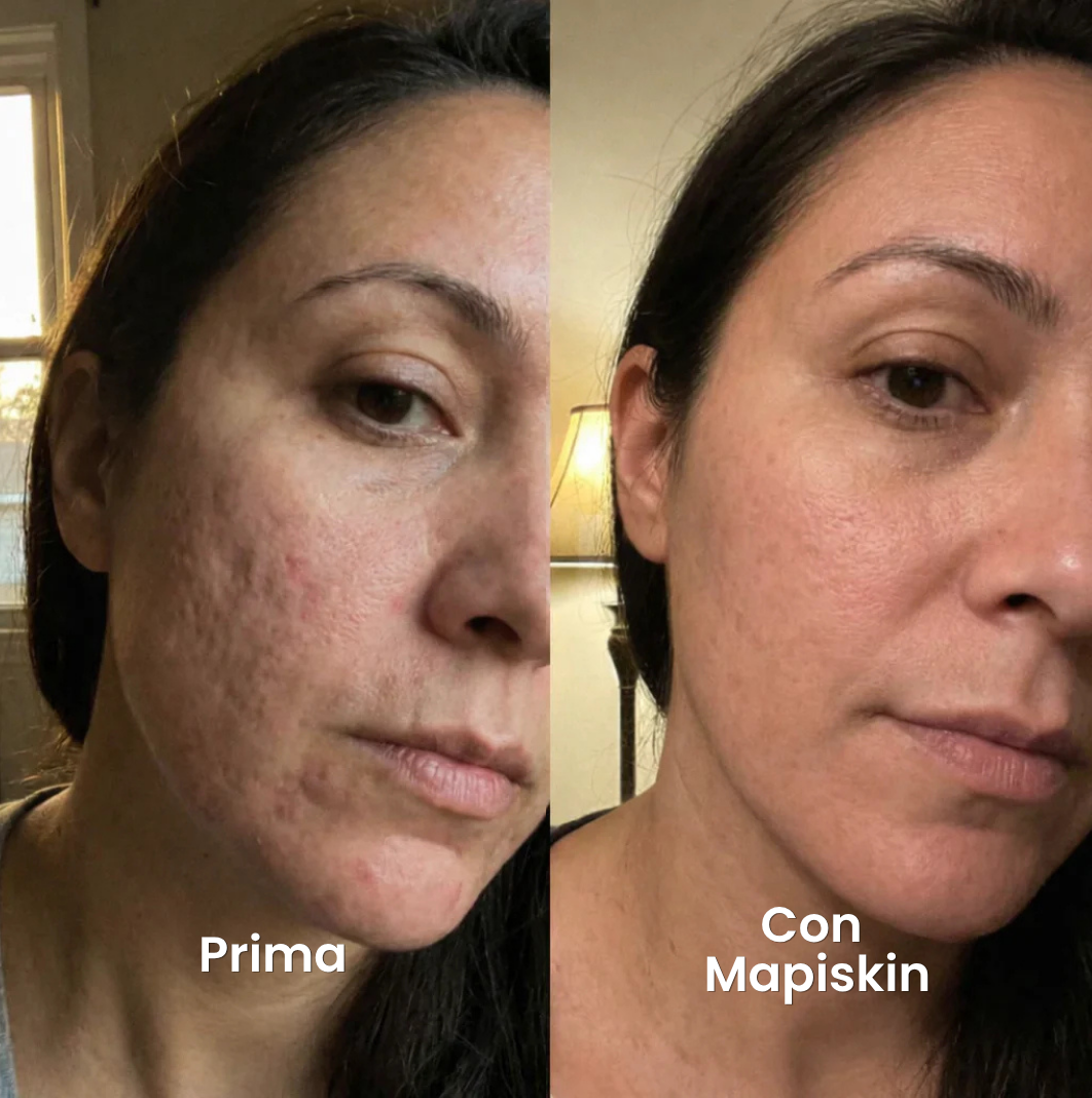 Sistema di micro-infusione per Cicatrici da Acne