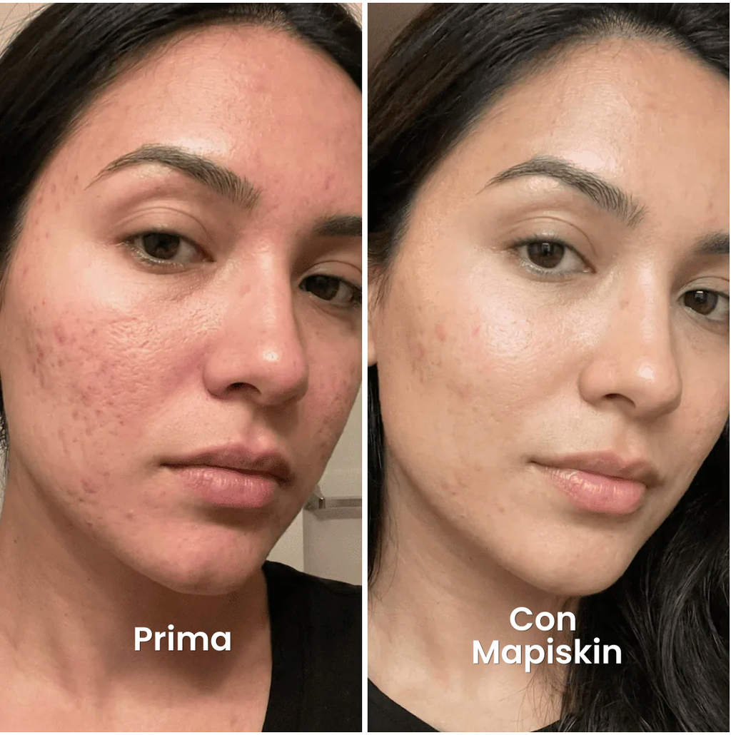 Sistema di micro-infusione per Cicatrici da Acne