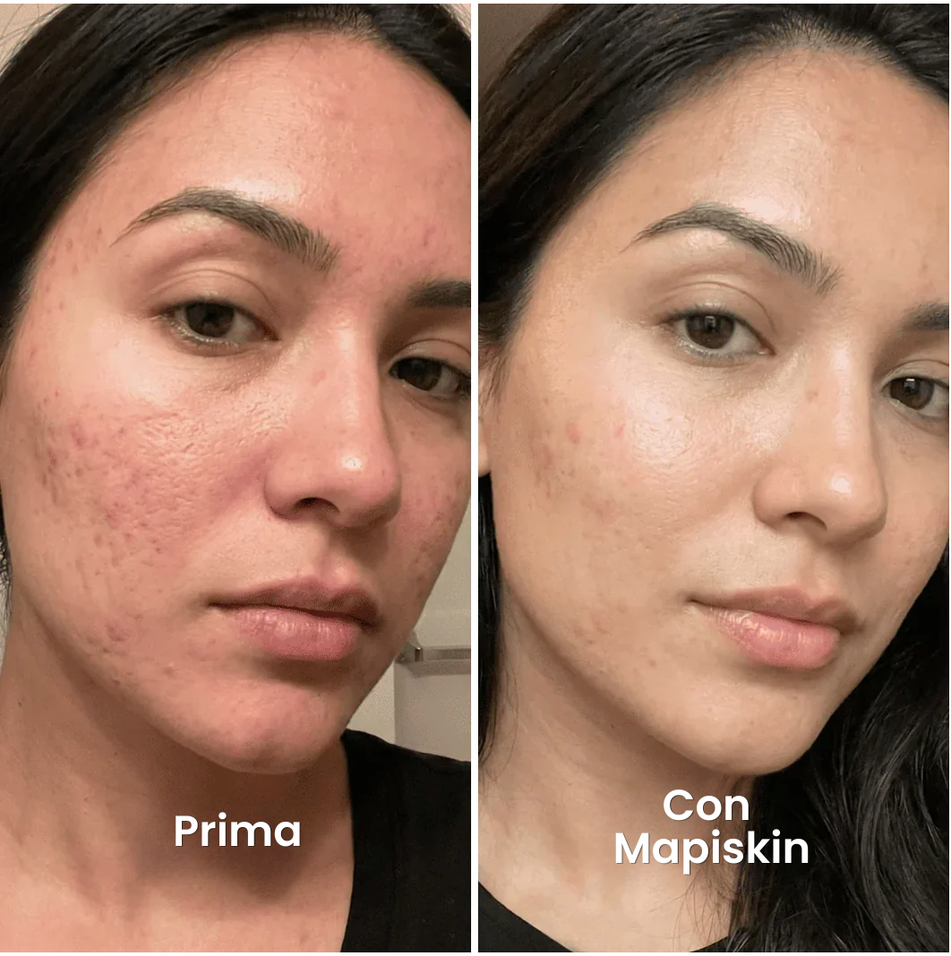 Sistema di micro-infusione per Cicatrici da Acne