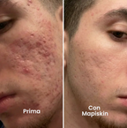 Sistema di micro-infusione per Cicatrici da Acne