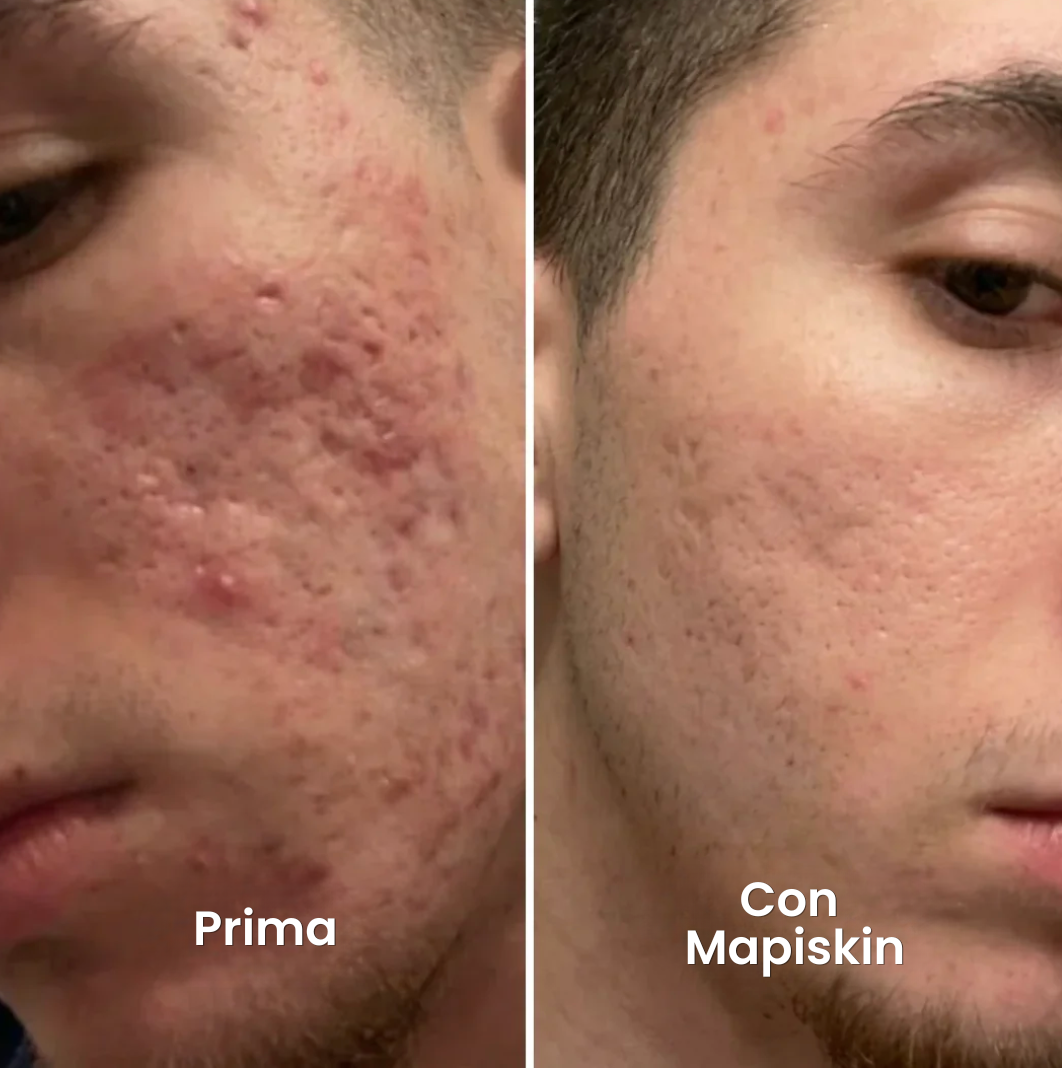 Sistema di micro-infusione per Cicatrici da Acne