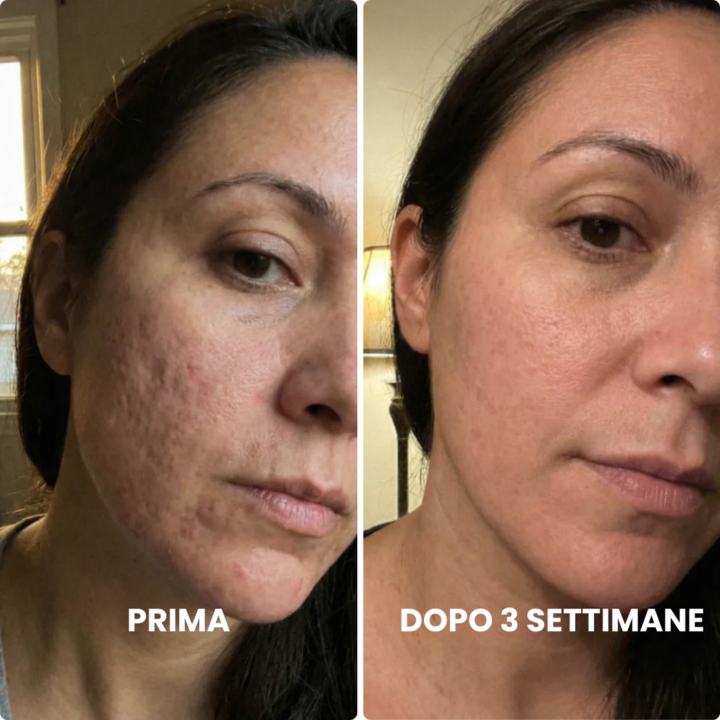 Stick Clinico per il Rimodellamento delle Cicatrici da Acne™